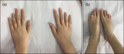 Next-Generation Sequencing Revealed Disease-Causing Variants in Two Genes in a Patient With Combined Features of Spherocytosis and Antley-Bixler Syndrome With Genital Anomalies and Disordered Steroidogenesis